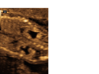 Hydronephrosis bilateral coronal